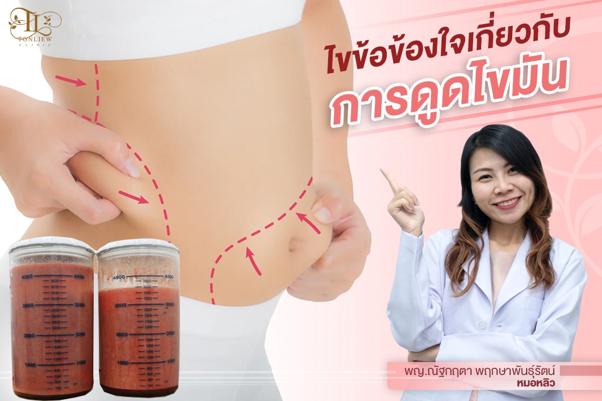 ไขข้อข้องใจเกี่ยวกับ การดูดไขมัน