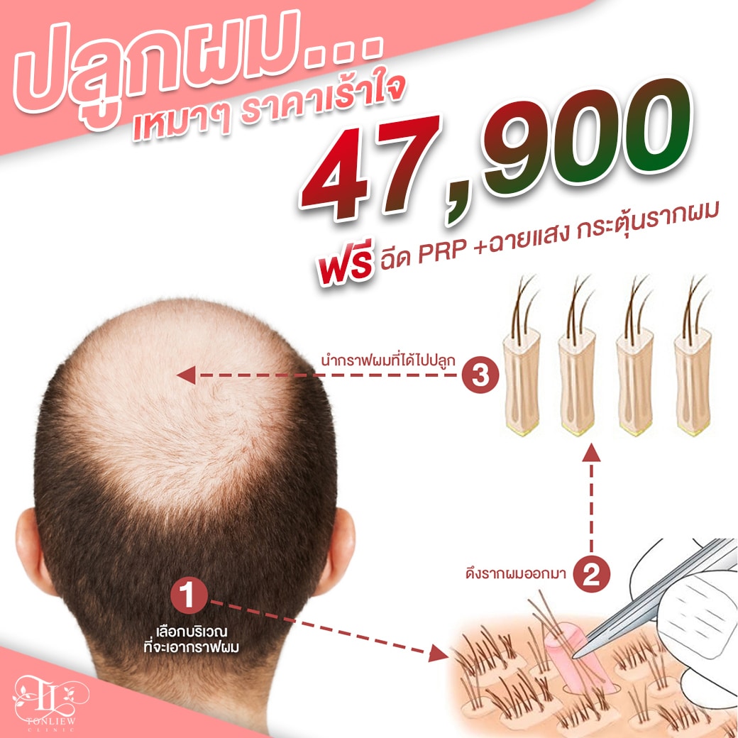 โปรโมชั่นปลูกผมถาวร ราคา 47900บาท