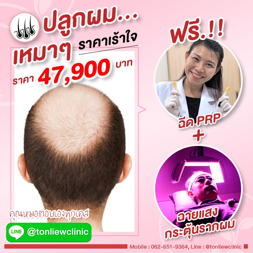 โปรโมชั่นปลูกผมถาวร ราคาถูก 47900บาท