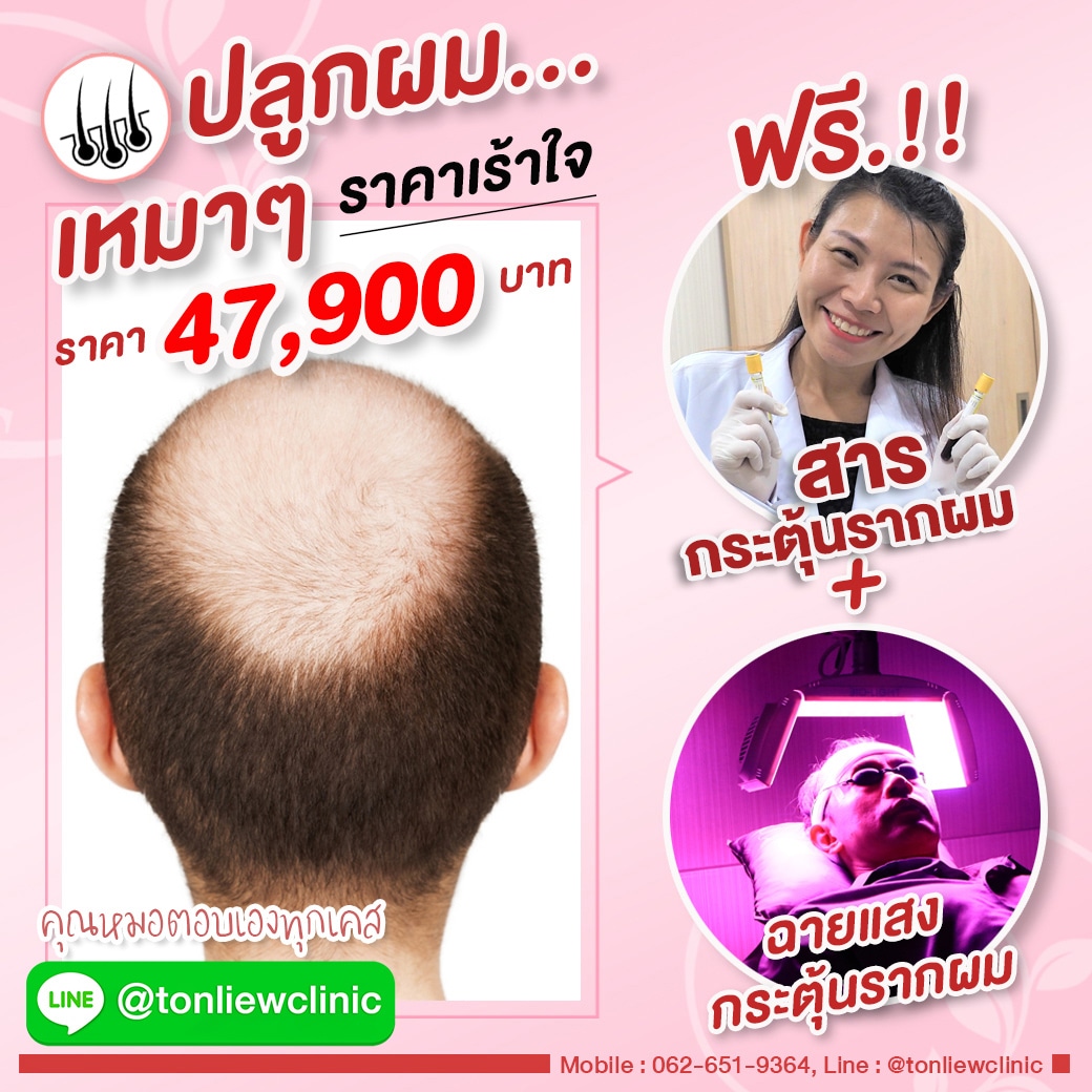 โปรโมชั่นปลูกผมถาวร ราคาถูก 47900บาท