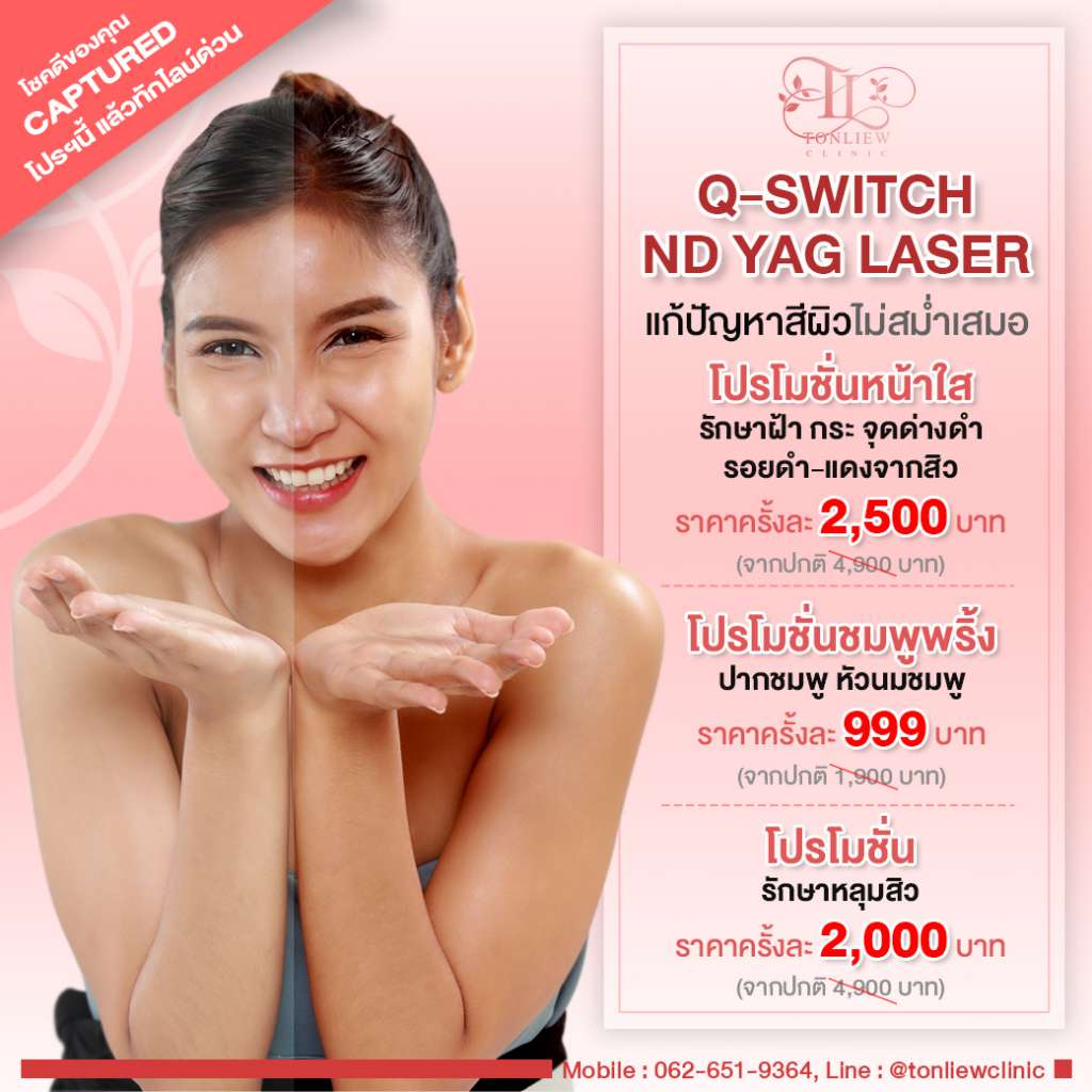 Q Switch ND Yag Laser Tonliew Clinic q-switch-nd-yag-laser-tonliew-clinic