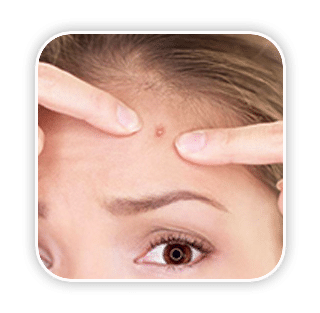 Acne, Reduce Sebum การรักษาสิว และการกำจัดต่อมไขมัน