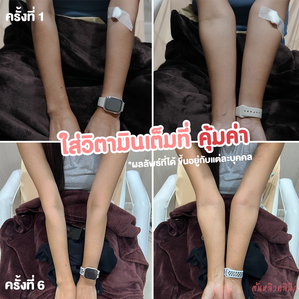 รีวิวฉีดวิตามินผิว ต้นหลิวคลินิก