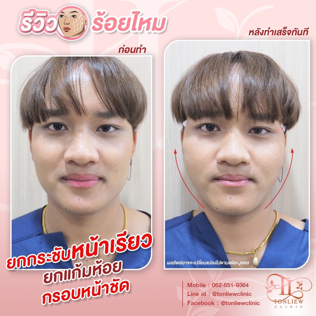 รีวิวร้อยไหม ต้นหลิวคลินิก