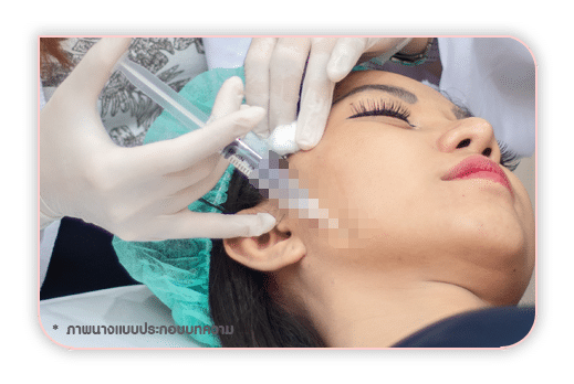 การร้อยไหมไม่ใช่การผ่าตัด แต่ก็มีความเจ็บจากการฉีดยาชาและจากการร้อยไหม การร้อยไหมไม่ใช่การผ่าตัด แต่ก็มีความเจ็บจากการฉีดยาชาและจากการร้อยไหม