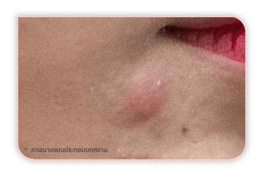 การร้อยไหมมีโอกาสทำให้ เกิดอาการผิวหนังบวมแดง การร้อยไหมมีโอกาสทำให้ เกิดอาการผิวหนังบวมแดง