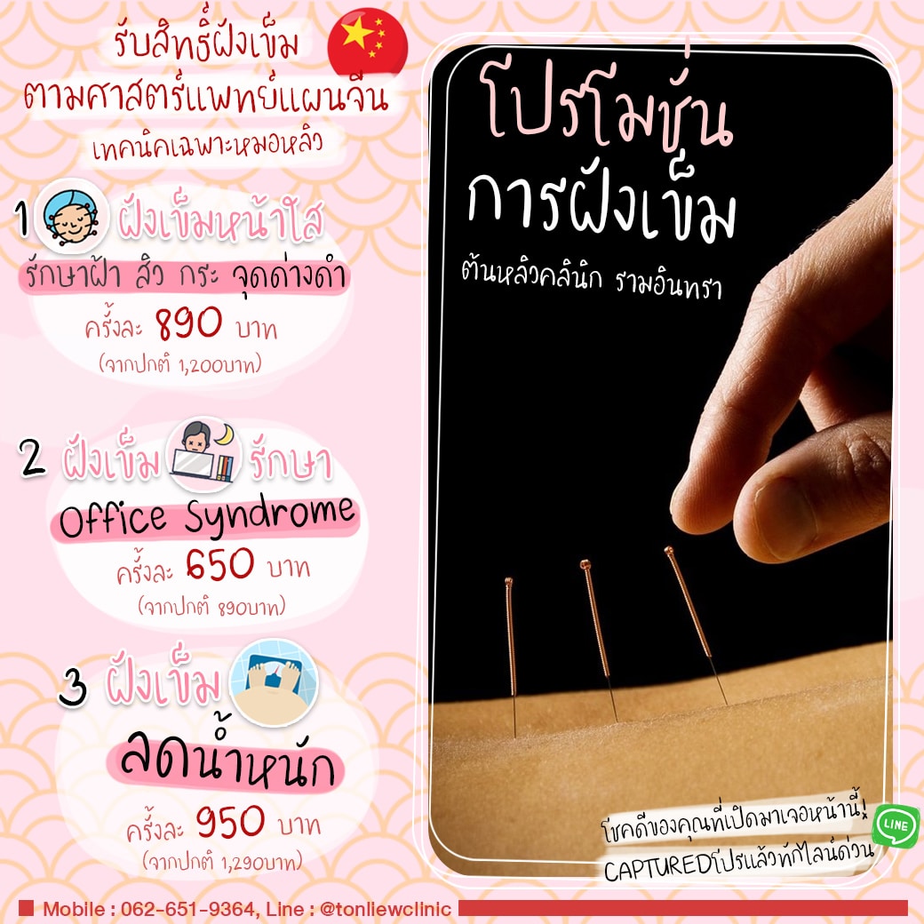 โปรโมชั่นฝังเข็ม ต้นหลิวคลินิก