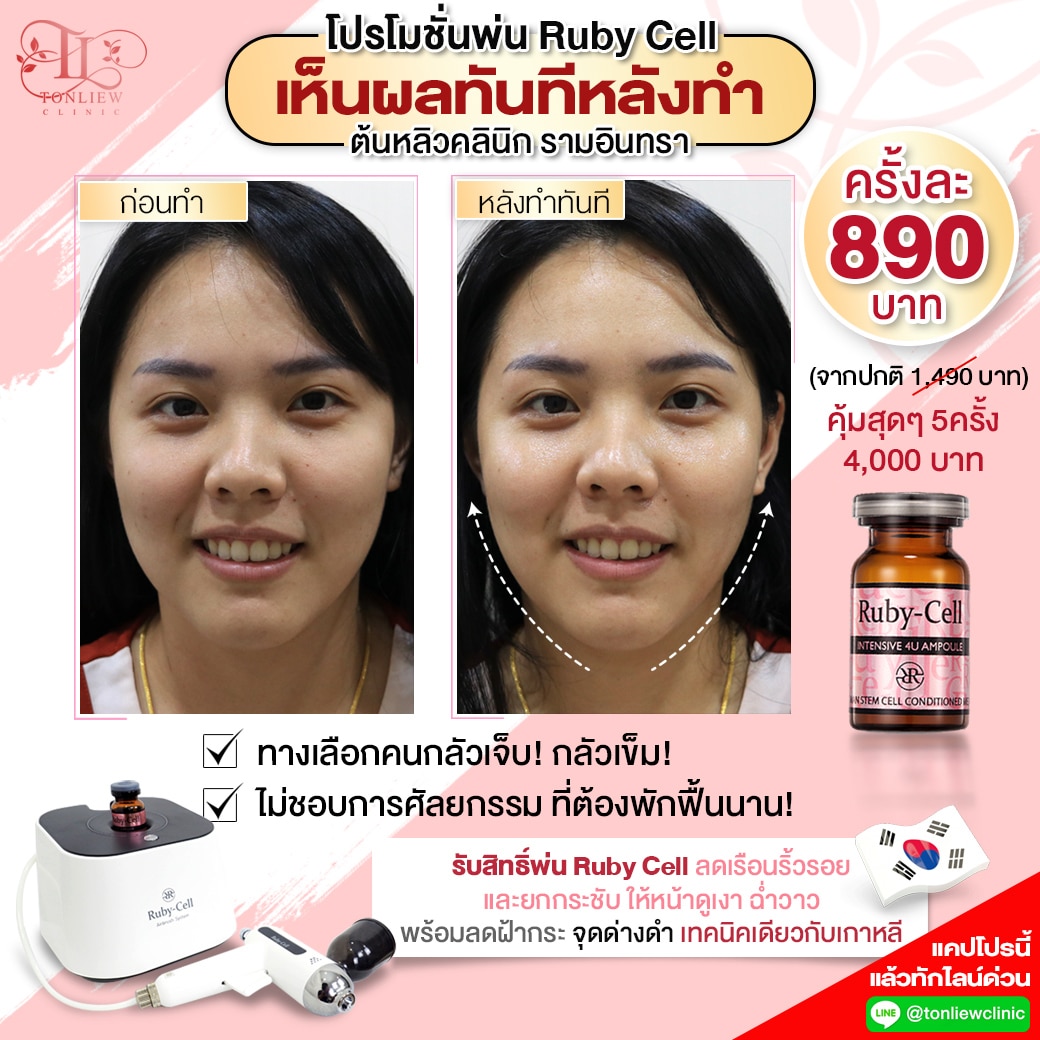 โปรโมชั่นพ่น RUBY CELL ต้นหลิวคลินิก