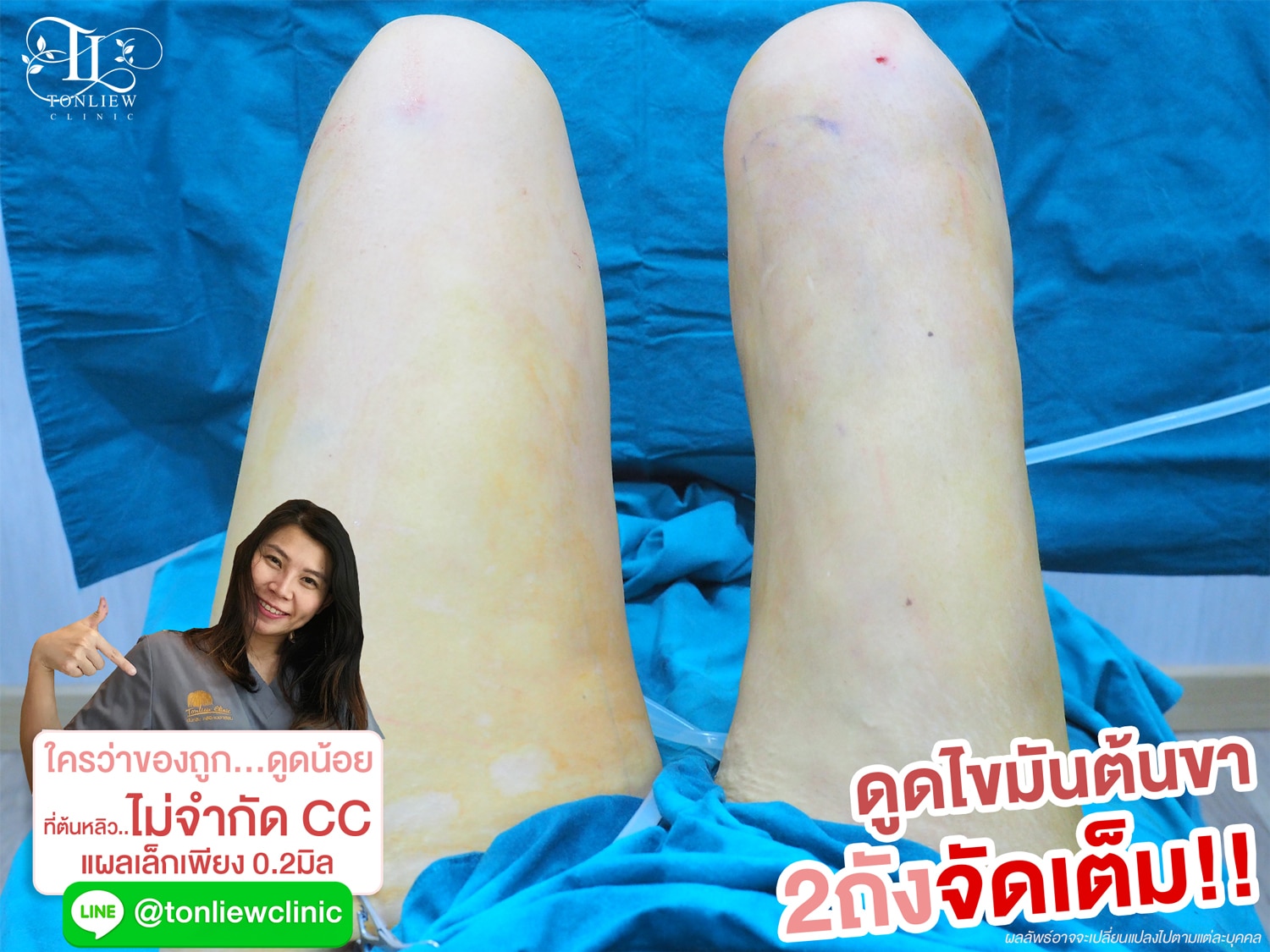 รีวิวดูดไขมันต้นขา พร้อมเหลา