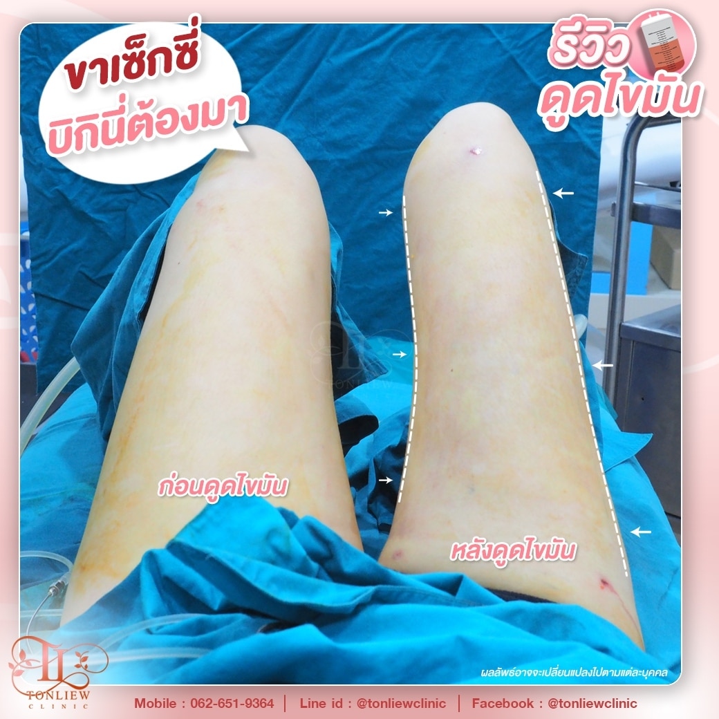 รีวิวดูดไขมันต้นขา ต้นหลิวคลินิก