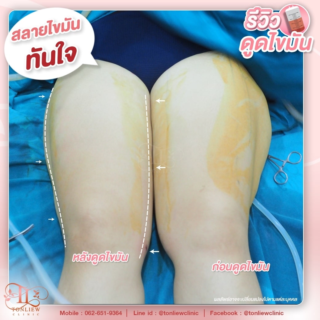 รีวิวดูดไขมันต้นขา ต้นหลิวคลินิก