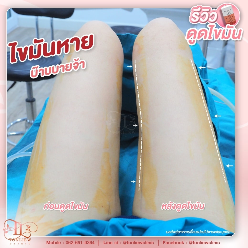 รีวิวดูดไขมันต้นขา ต้นหลิวคลินิก
