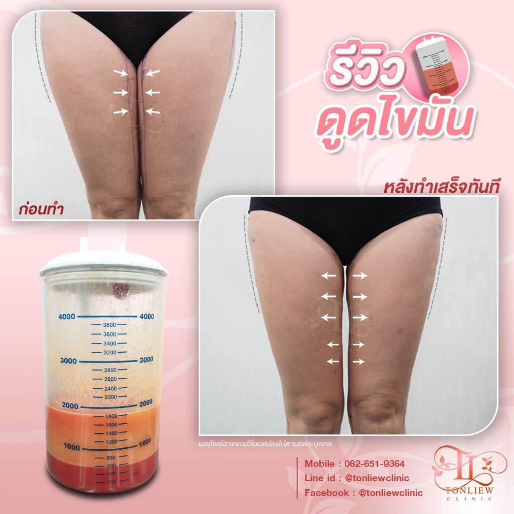 ดูดไขมันต้นขา โปรโมชั่นราคาถูก เหมาไม่จำกัด | Tonliew Clinic ดูดไขมันต้นขา โปรโมชั่นราคาถูก เหมาไม่จำกัด | Tonliew Clinic
