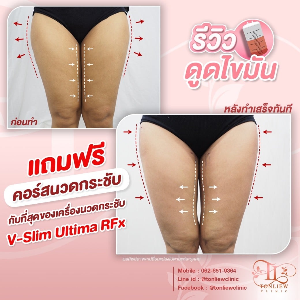 รีวิวดูดไขมันต้นขา ต้นหลิวคลินิก