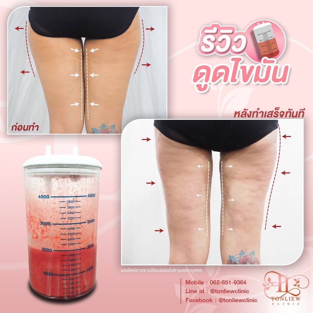 รีวิวดูดไขมันต้นขา ต้นหลิวคลินิก