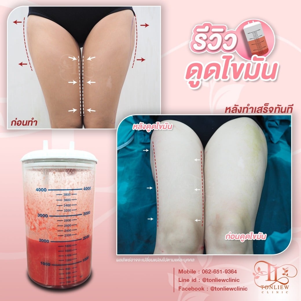 รีวิวดูดไขมันต้นขา