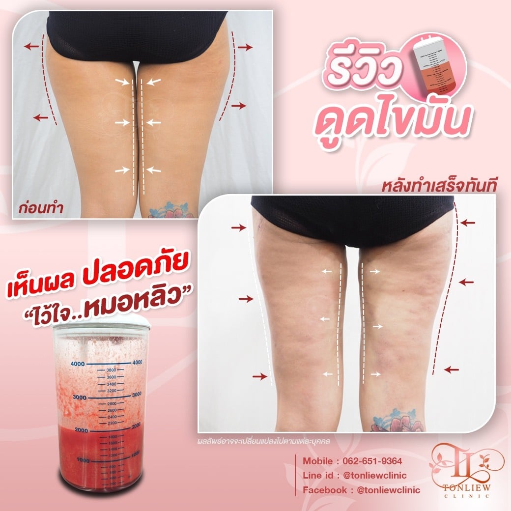 รีวิวดูดไขมันต้นขา