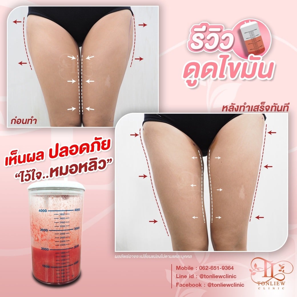 รีวิวดูดไขมันต้นขา