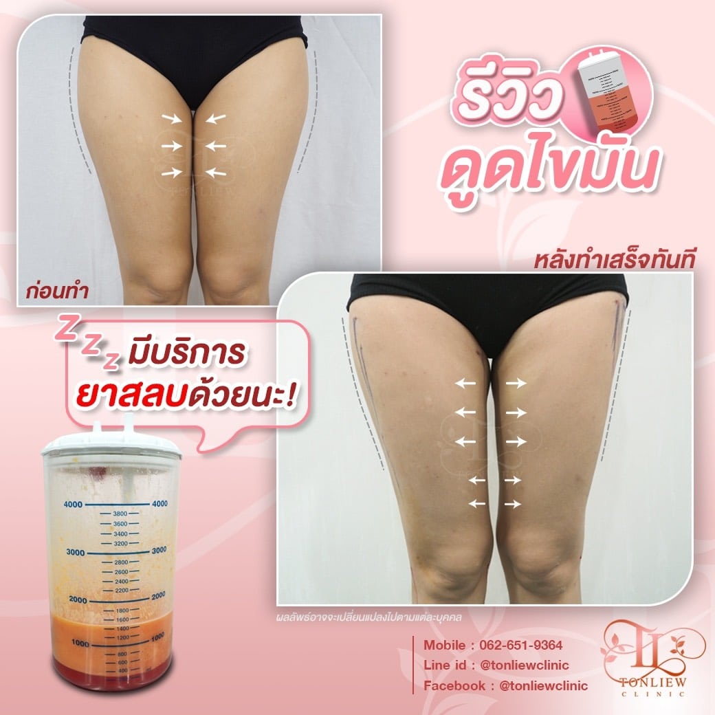 ก่อนดูด หลังดูดไขมันต้นขา