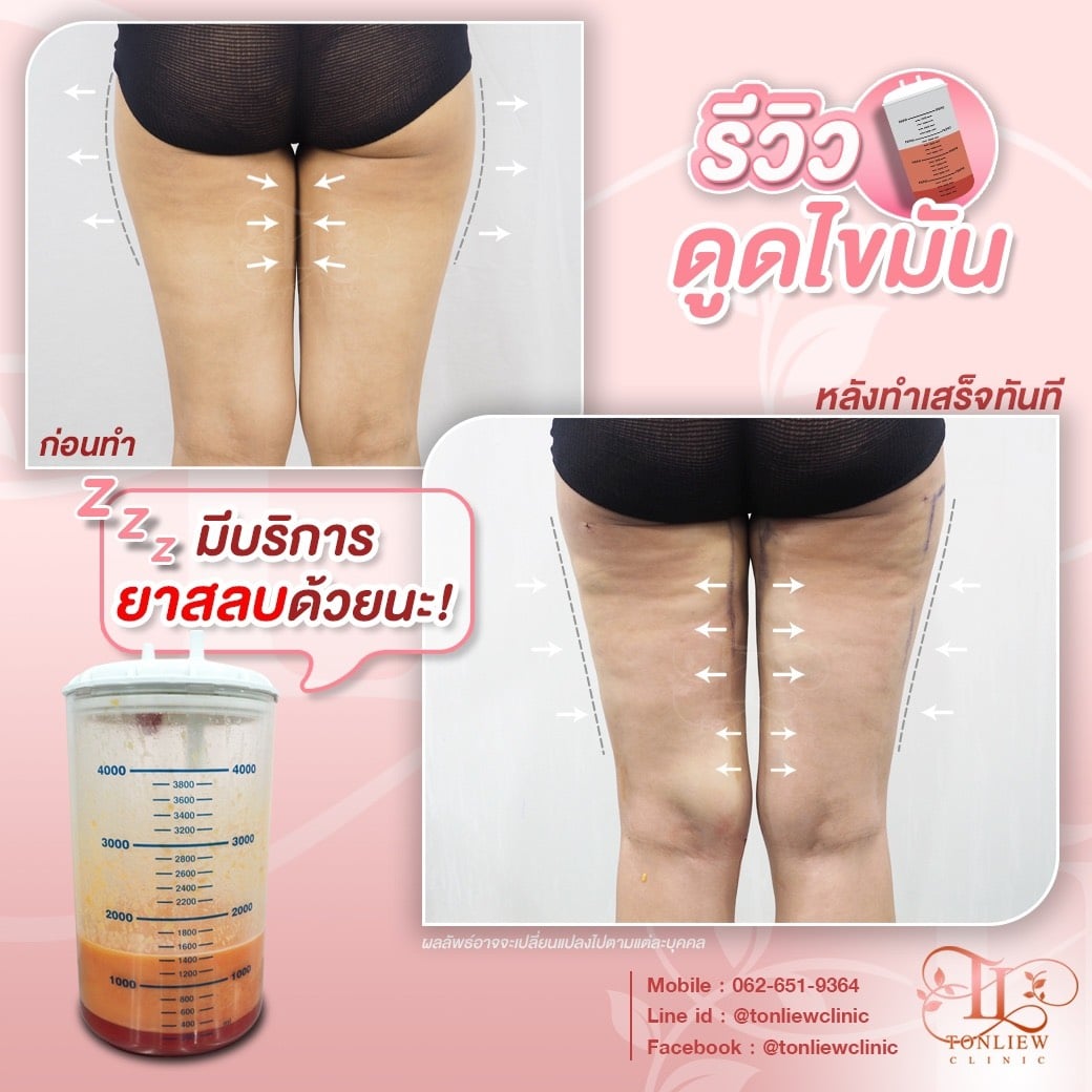 ก่อนดูด หลังดูดไขมันต้นขา