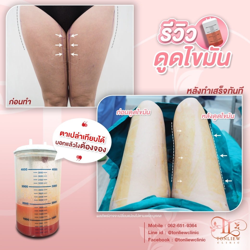 ก่อนดูด หลังดูดไขมันต้นขา