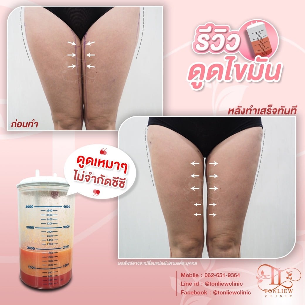 ก่อนดูด หลังดูดไขมันต้นขา