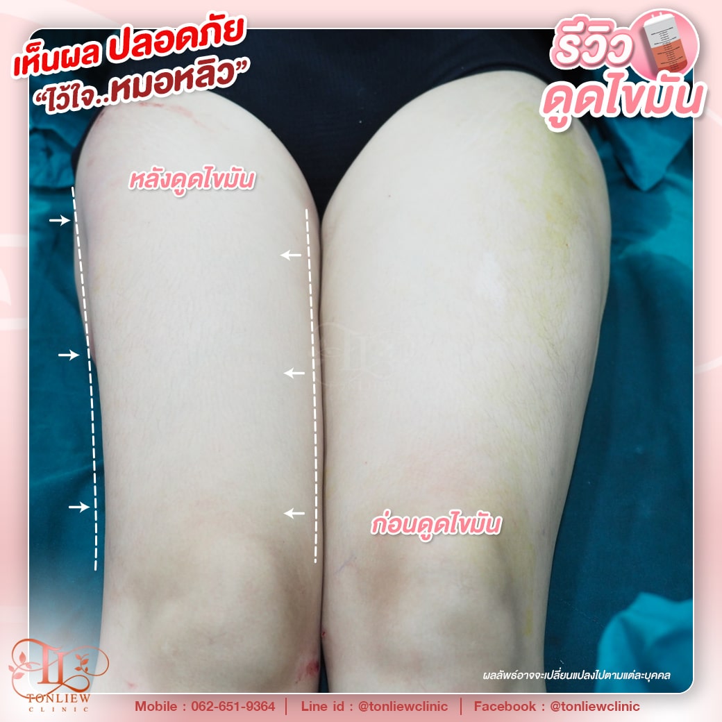 รีวิวดูดไขมันต้นขา ต้นหลิวคลินิก