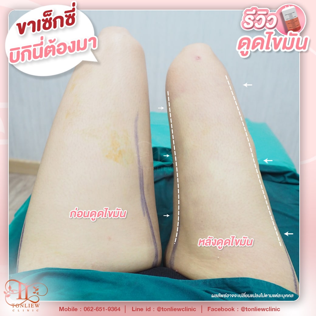 รีวิวดูดไขมันต้นขา ต้นหลิวคลินิก