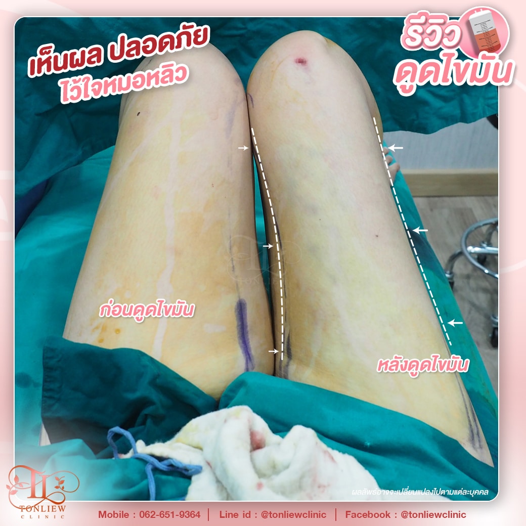 รีวิวดูดไขมันต้นขา ต้นหลิวคลินิก