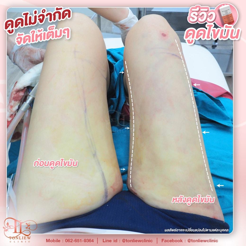 รีวิวดูดไขมันต้นขา ต้นหลิวคลินิก