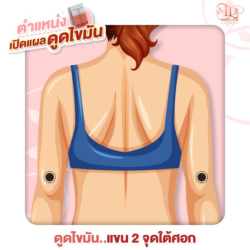 เปิดแผล ดูดไขมันต้นแขน