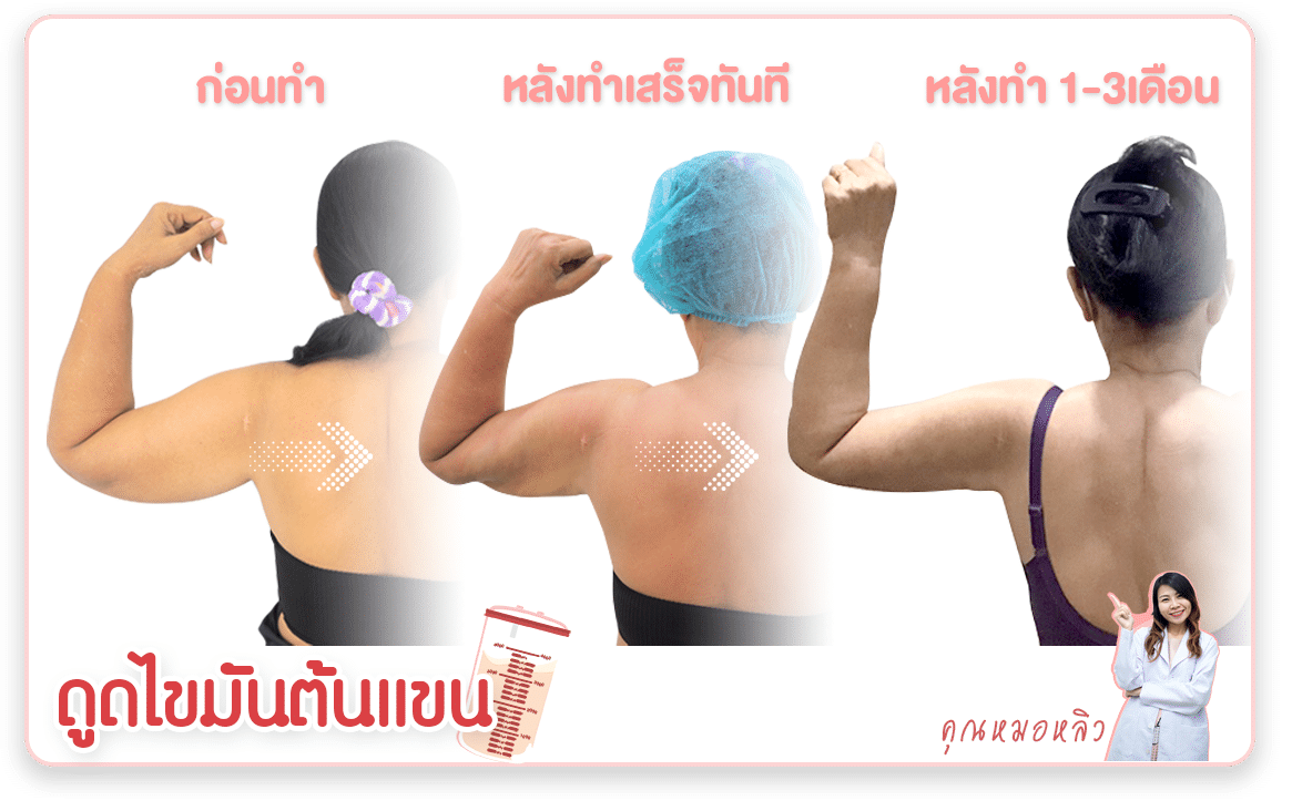 รีวิวก่อนหลัง ดูดไขมันต้นแขน ต้นหลิวคลินิก