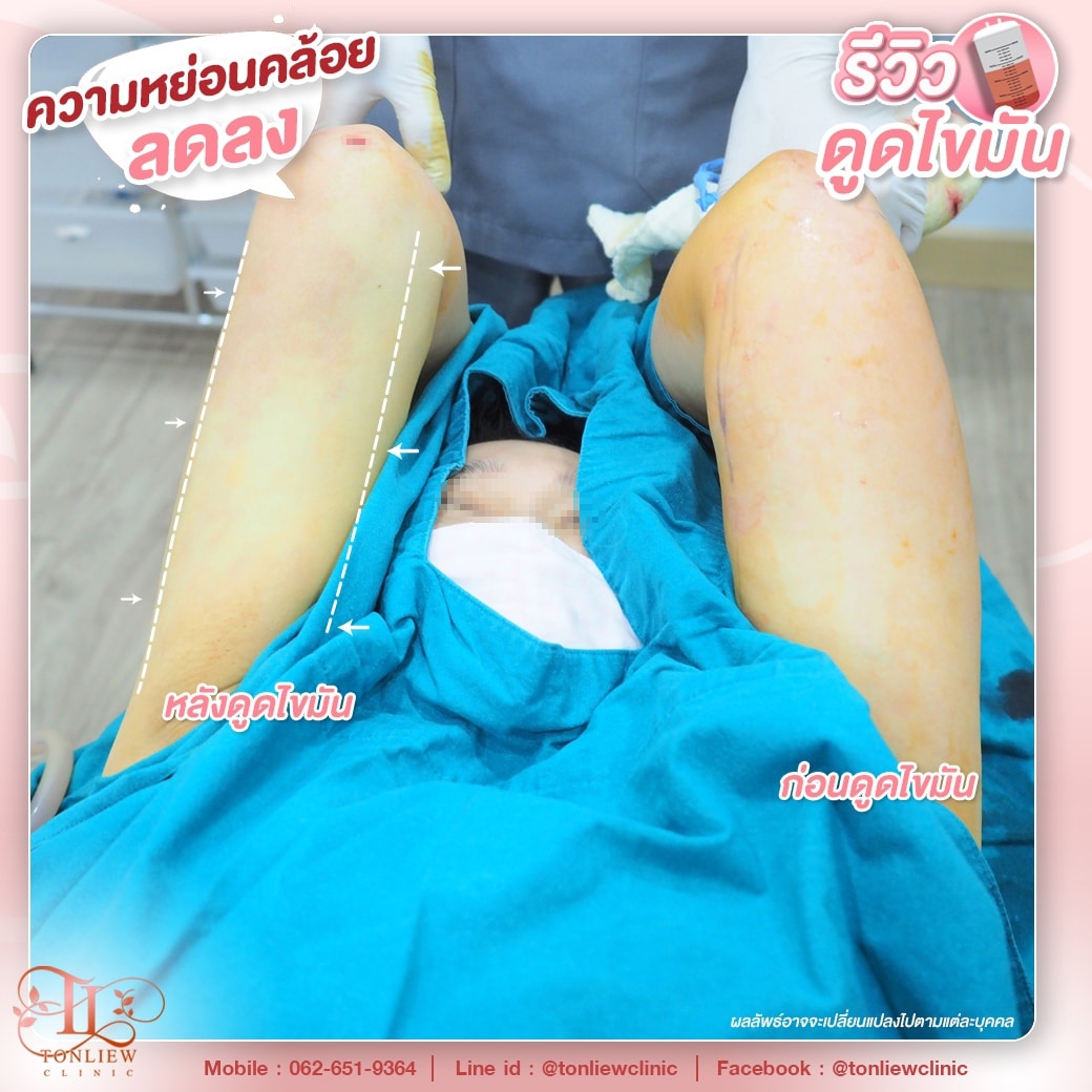 รีวิวดูดไขมันต้นแขน