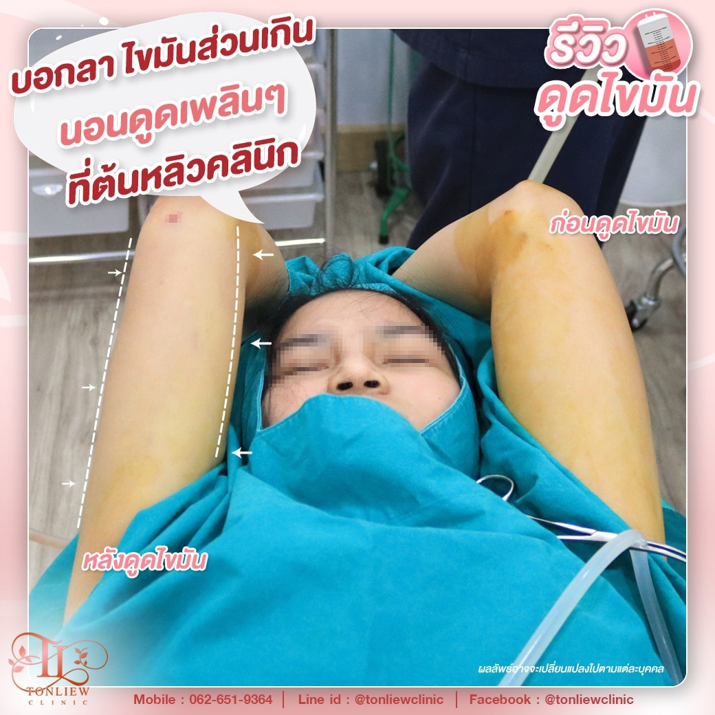 รีวิวดูดไขมันต้นแขน ต้นหลิวคลินิก