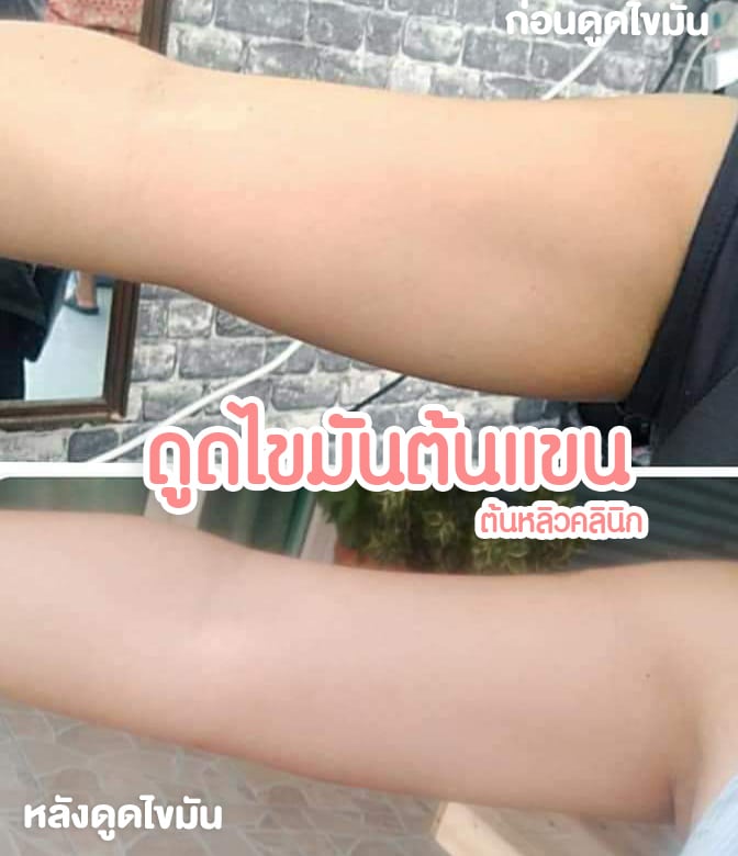 รีวิวดูดไขมันต้นแขน ต้นหลิวคลินิก
