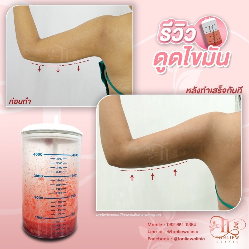 รีวิวดูดไขมันต้นแขน หมอหลิว