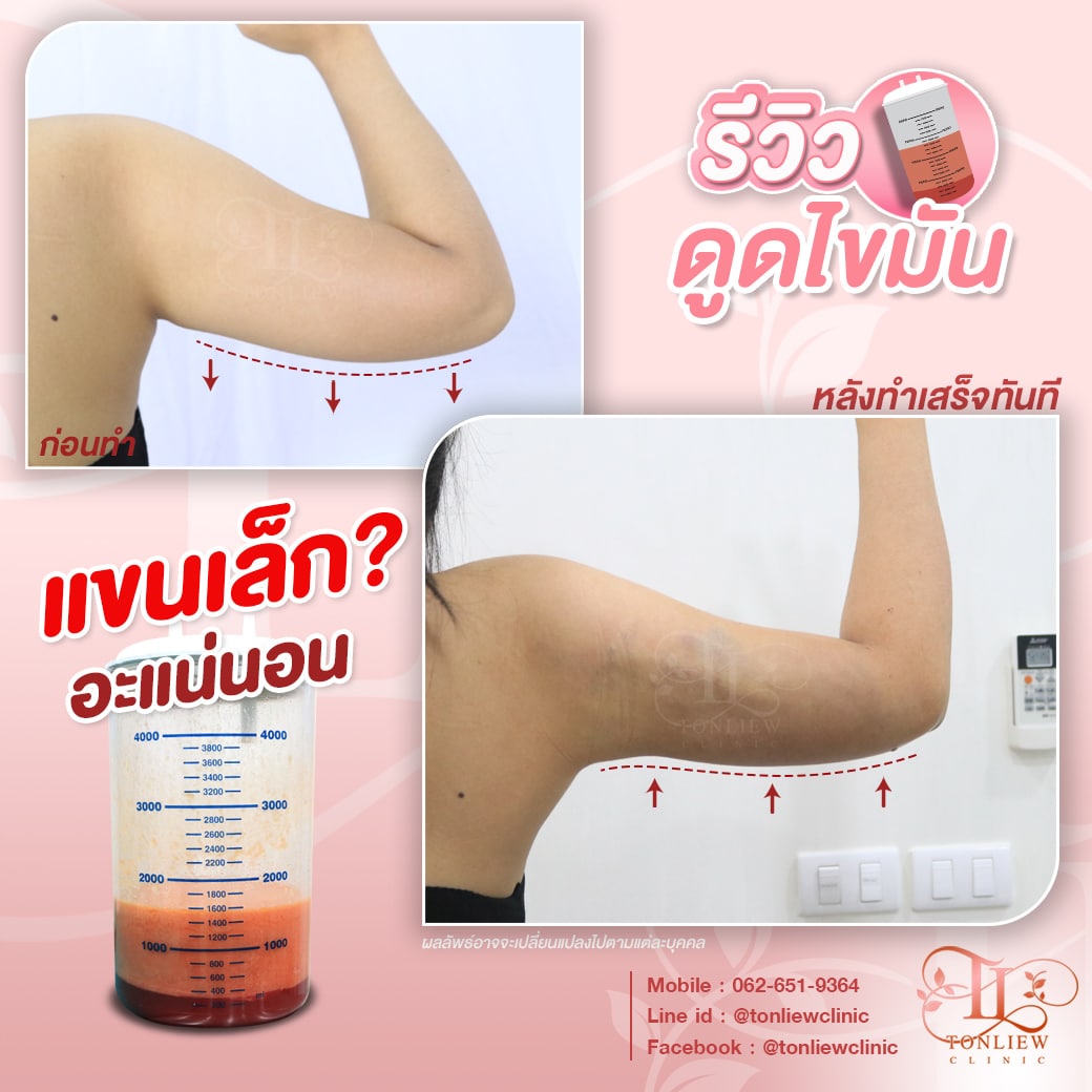 รีวิวดูดไขมันต้นแขน หมอหลิว