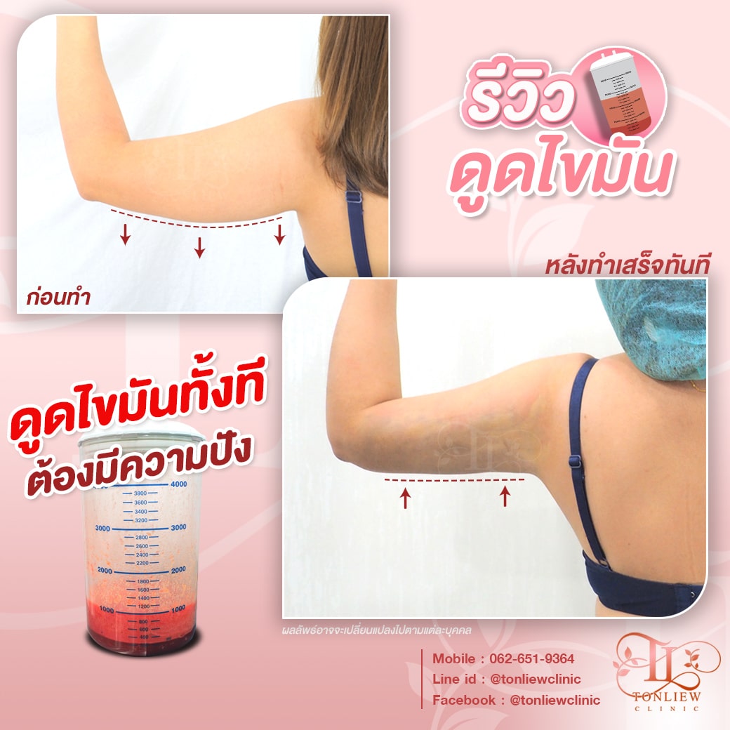 รีวิวดูดไขมันต้นแขน