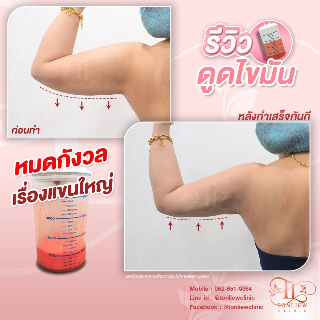 รีวิวดูดไขมันต้นแขน