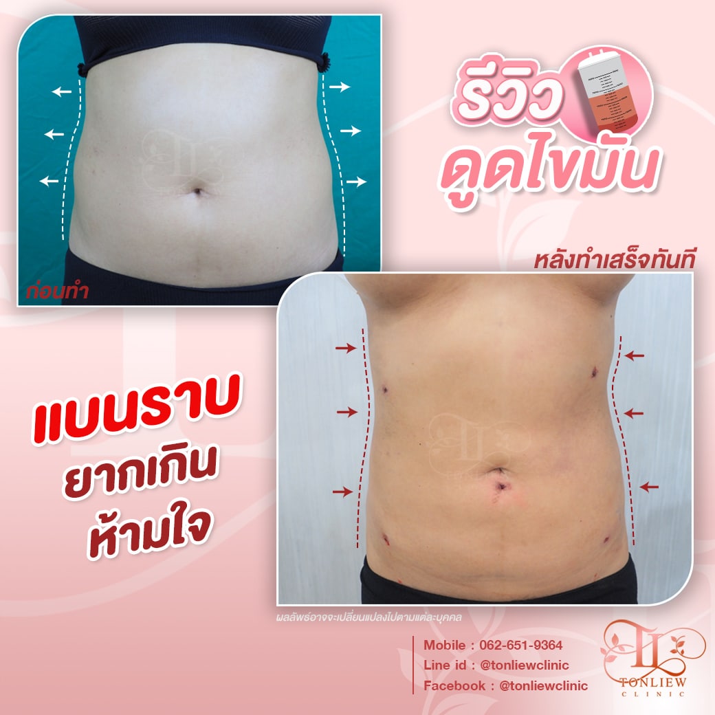รีวิวดูดไขมันหน้าท้อง ต้นหลิวคลินิก
