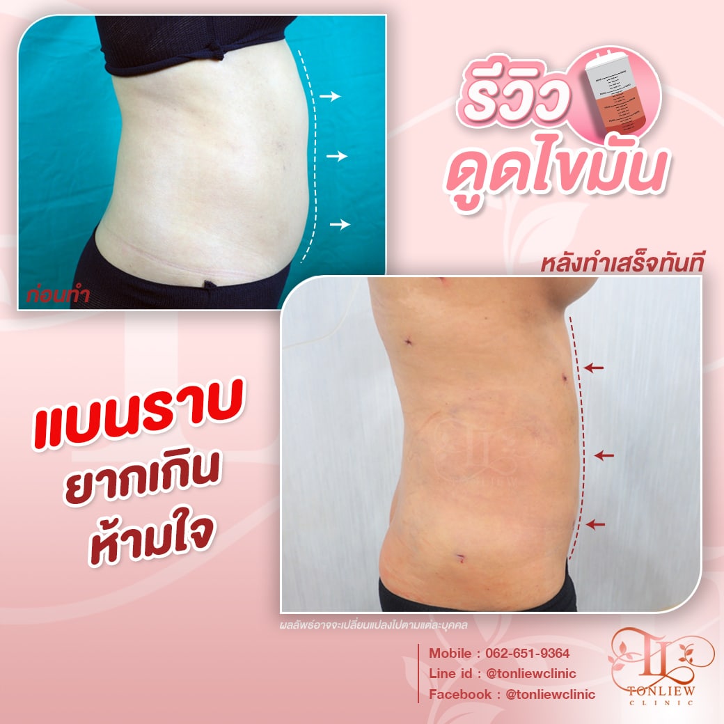 รีวิวดูดไขมันหน้าท้อง ต้นหลิวคลินิก