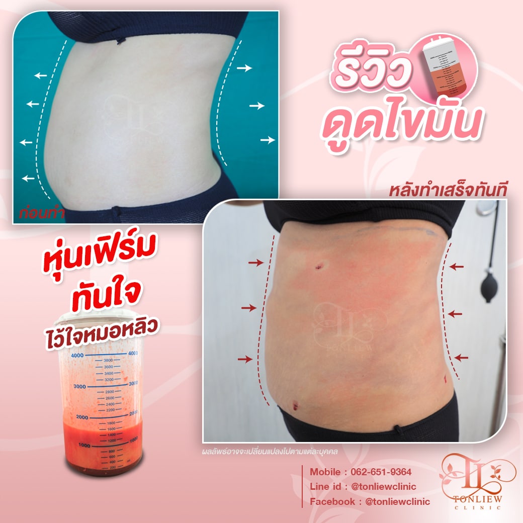 รีวิวดูดไขมันหน้าท้อง ต้นหลิวคลินิก