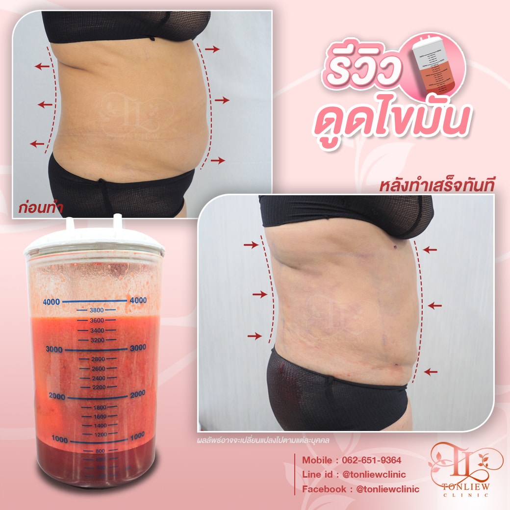 รีวิวดูดไขมันหน้าท้อง ต้นหลิวคลินิก