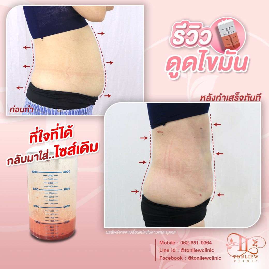 รีวิวดูดไขมันหน้าท้อง ต้นหลิวคลินิก