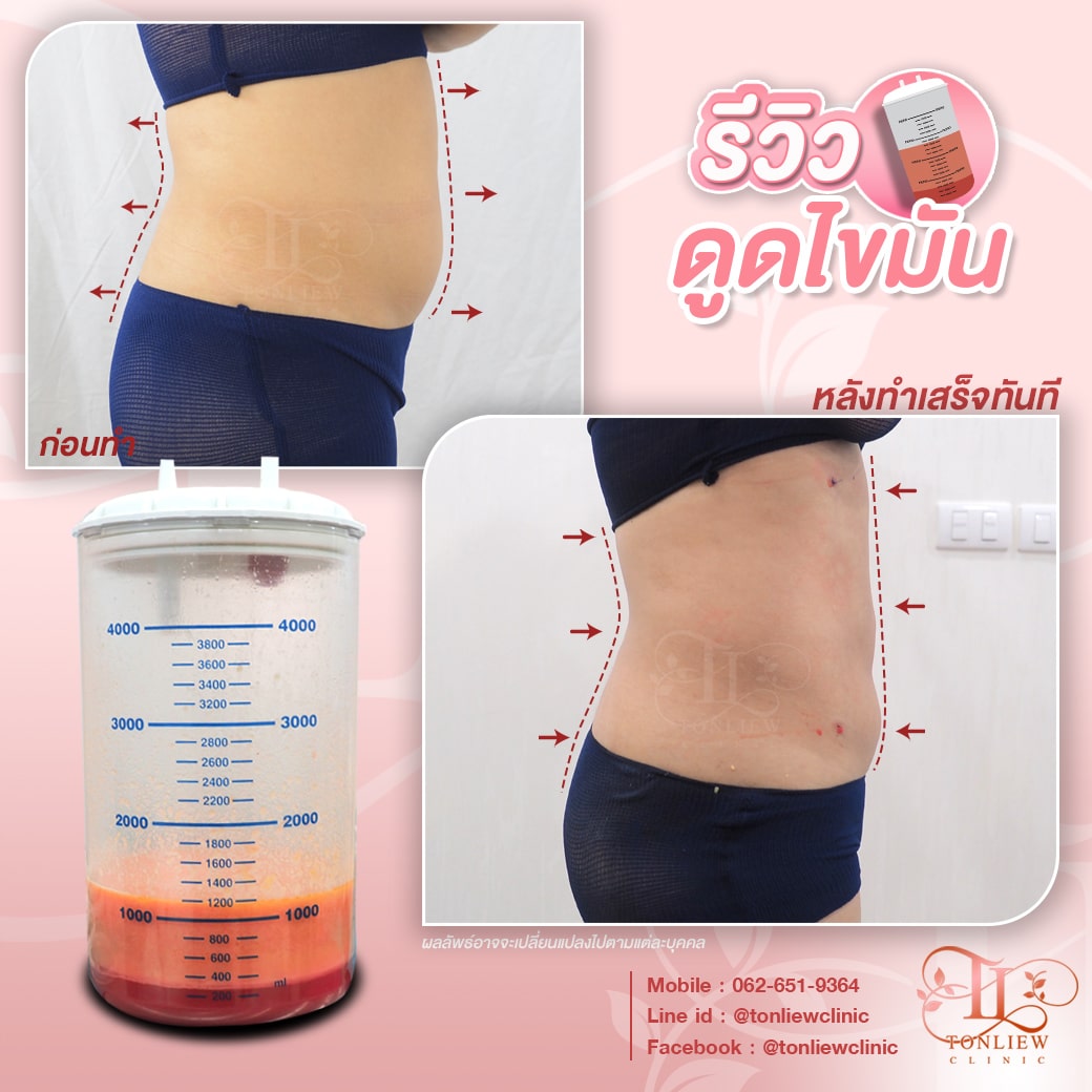 รีวิวดูดไขมันหน้าท้อง ต้นหลิวคลินิก
