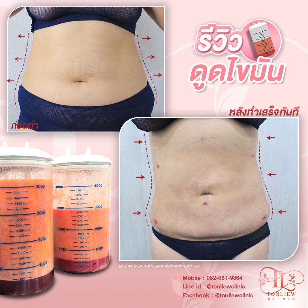 รีวิวดูดไขมันหน้าท้อง ต้นหลิวคลินิก