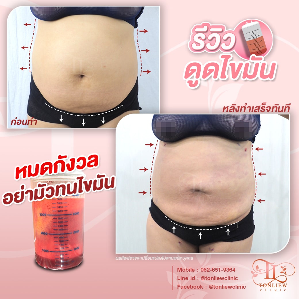 รีวิวดูดไขมันหน้าท้อง ต้นหลิวคลินิก