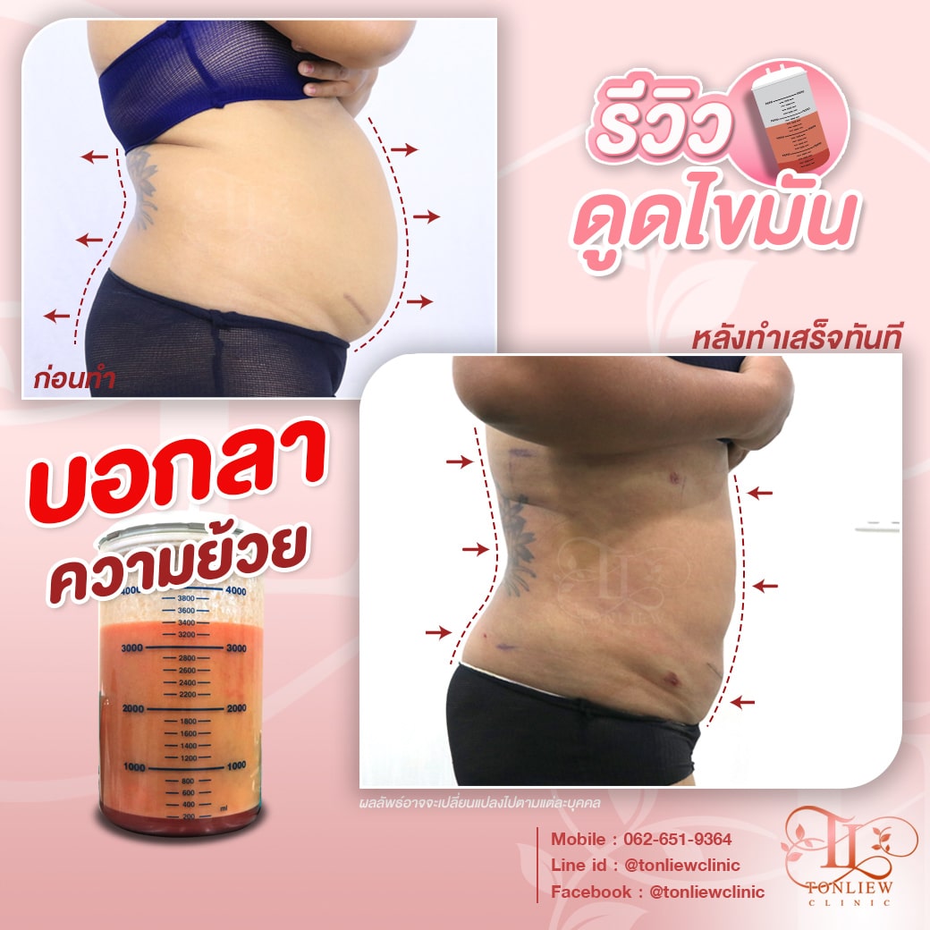 รีวิวดูดไขมันหน้าท้อง ต้นหลิวคลินิก