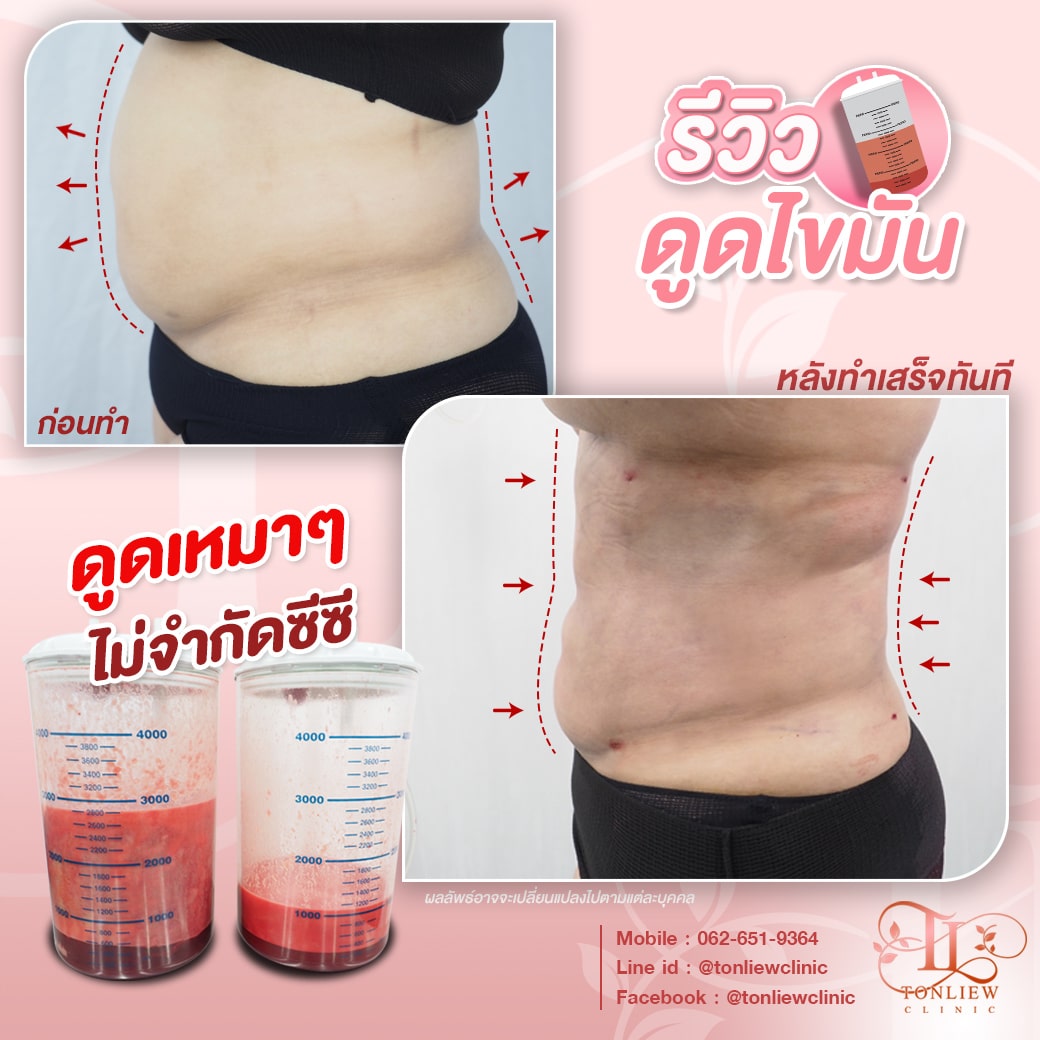 รีวิวดูดไขมันหน้าท้อง ต้นหลิวคลินิก