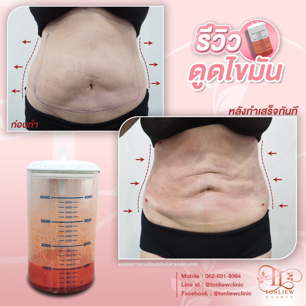 รีวิวดูดไขมันหน้าท้อง ต้นหลิวคลินิก